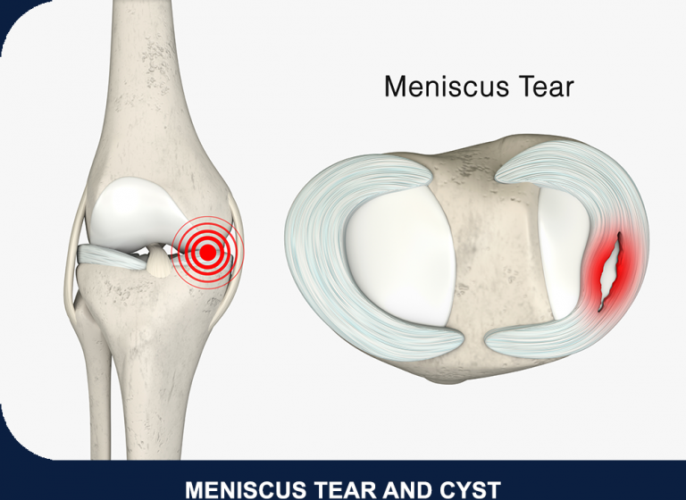 Meniscus Tear Treatment in Singapore - Quantum Orthopaedics